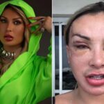Andressa Urach sob os holofotes: especialista destaca os perigos de 50 intervenções cirúrgicas estéticas
