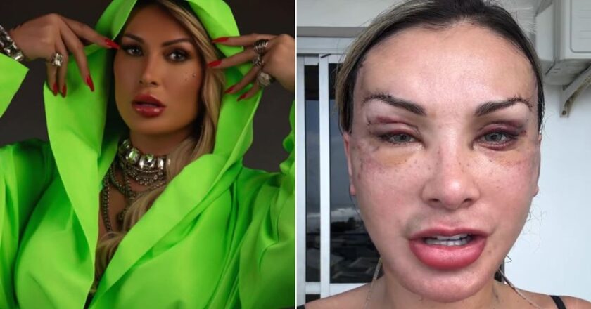 Andressa Urach sob os holofotes: especialista destaca os perigos de 50 intervenções cirúrgicas estéticas